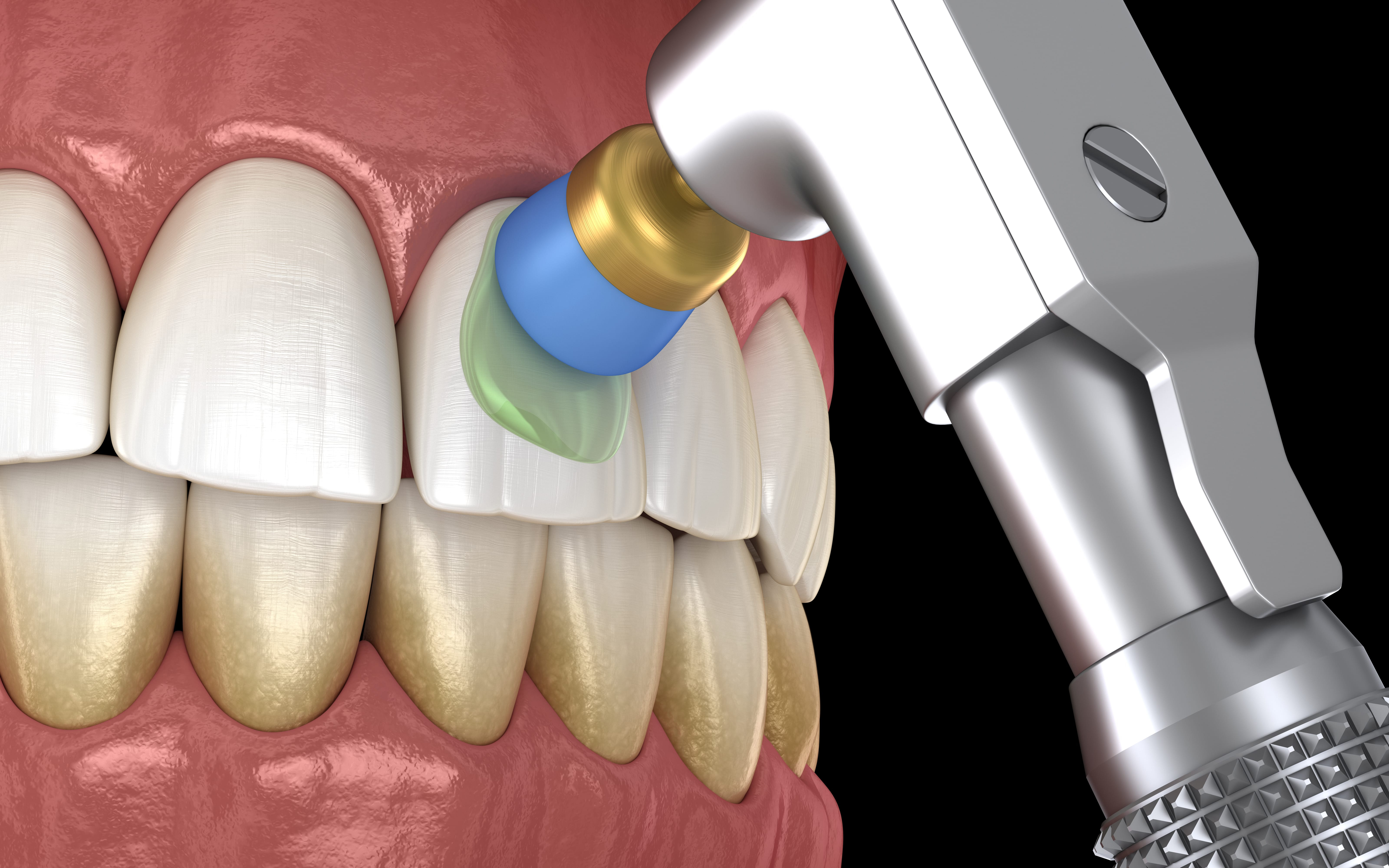DENTAL SCALING & POLISHING