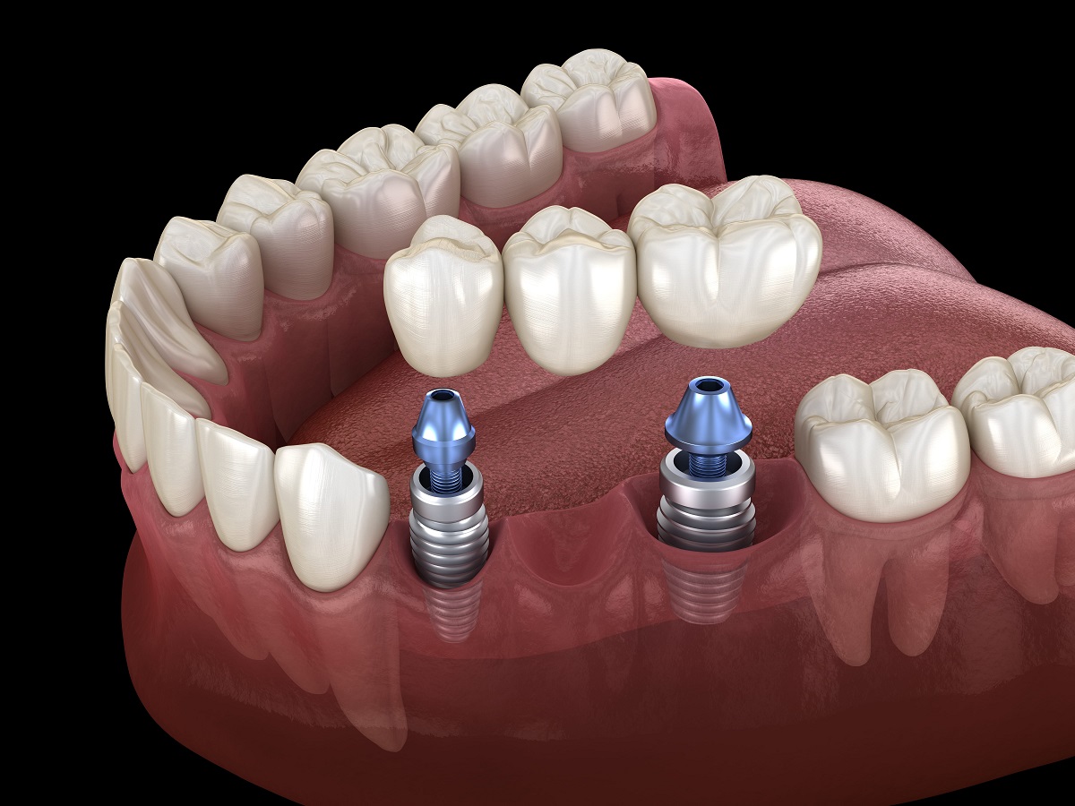 IMPLANT-SUPPORTED CROWNS/BRIDGES