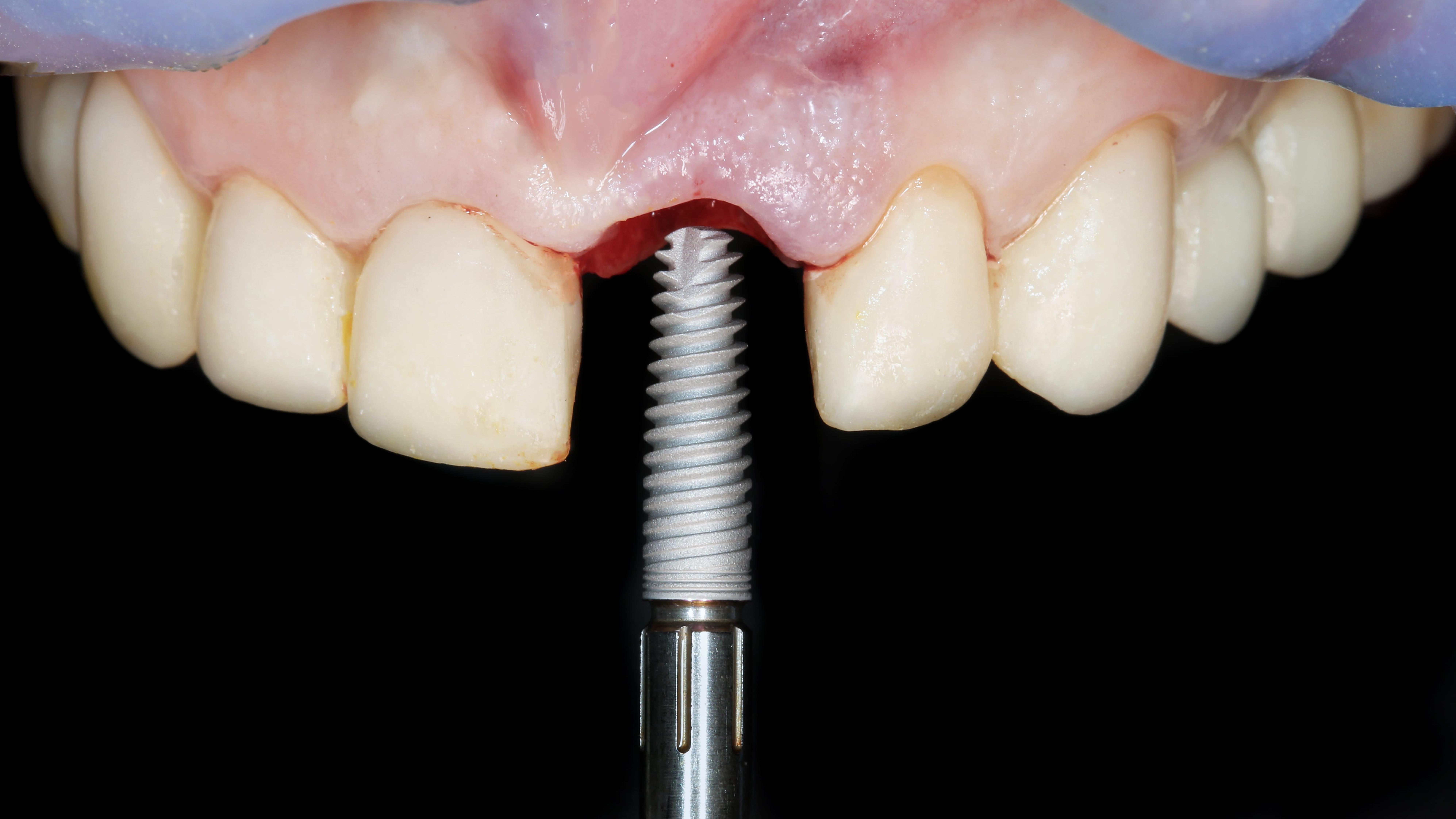 SINGLE VISIT OR IMMEDIATE IMPLANTOLOGY