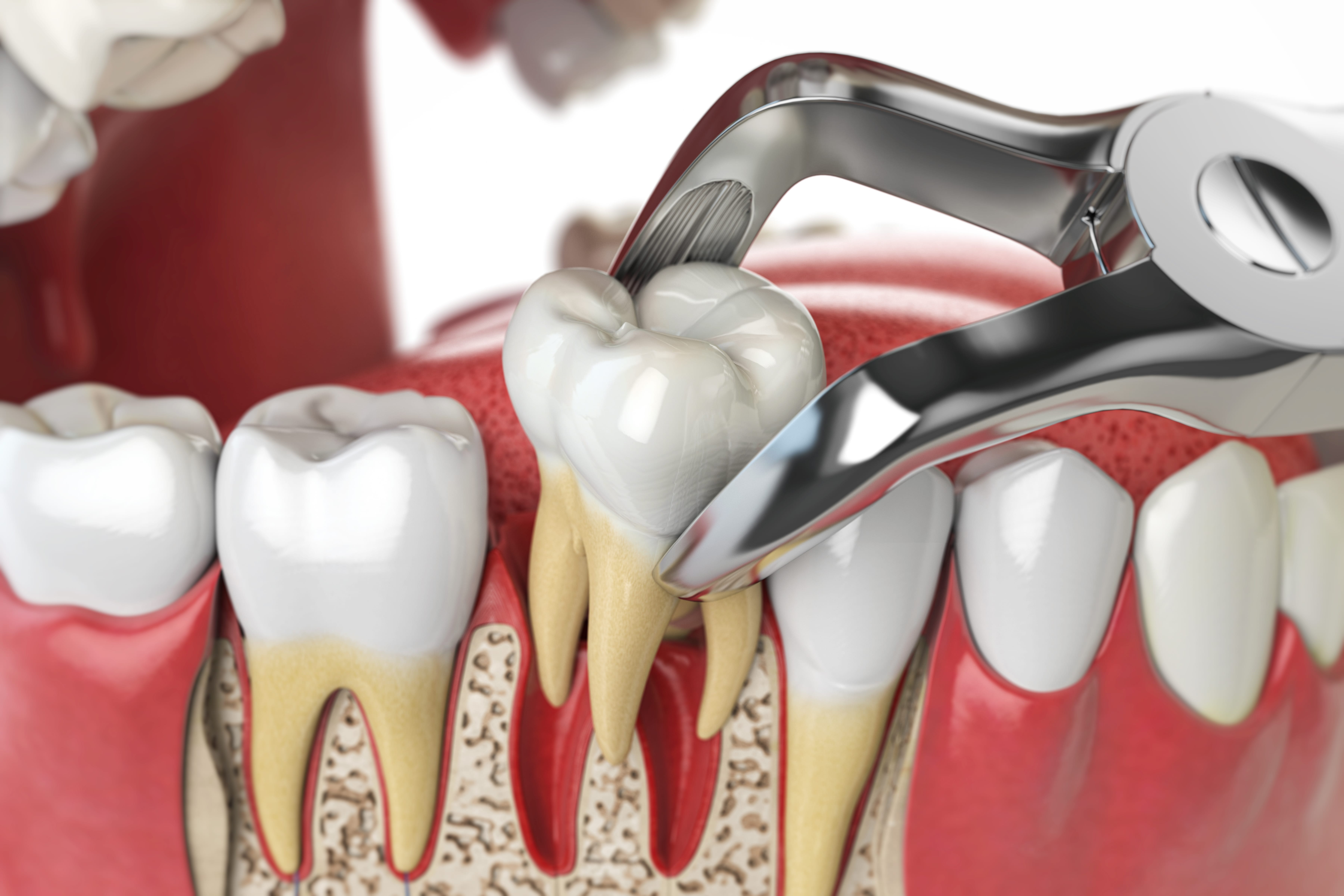 TOOTH EXTRACTION / SURGICAL TREATMENTS